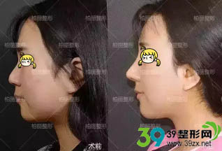 在北京柏丽做完鼻综合整形术前后对比
